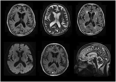 Case report: A longitudinal study of an unusual rapidly progressive dementia case